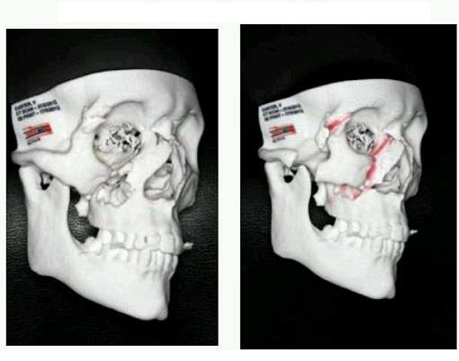 Life threatening injuries caused by car accident in 2004